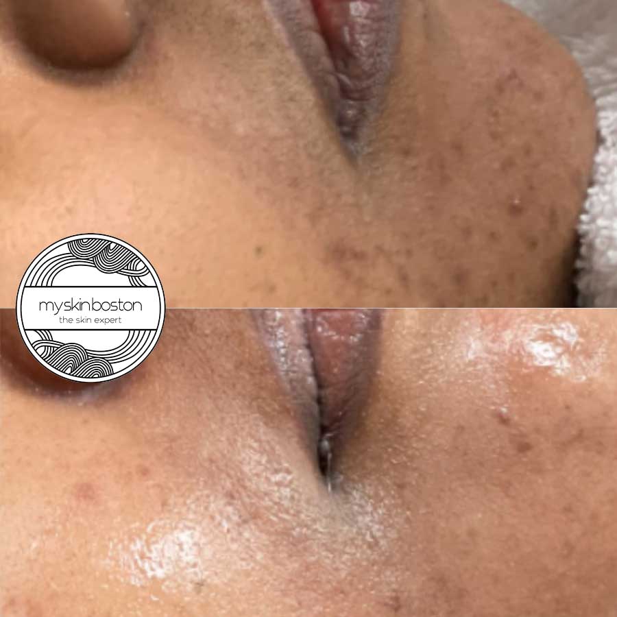 Acne Facial Before and After