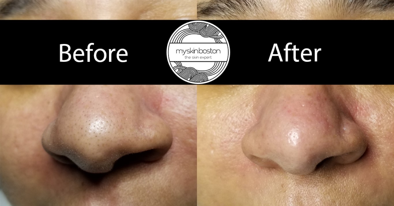 Blackhead Removal Before and After