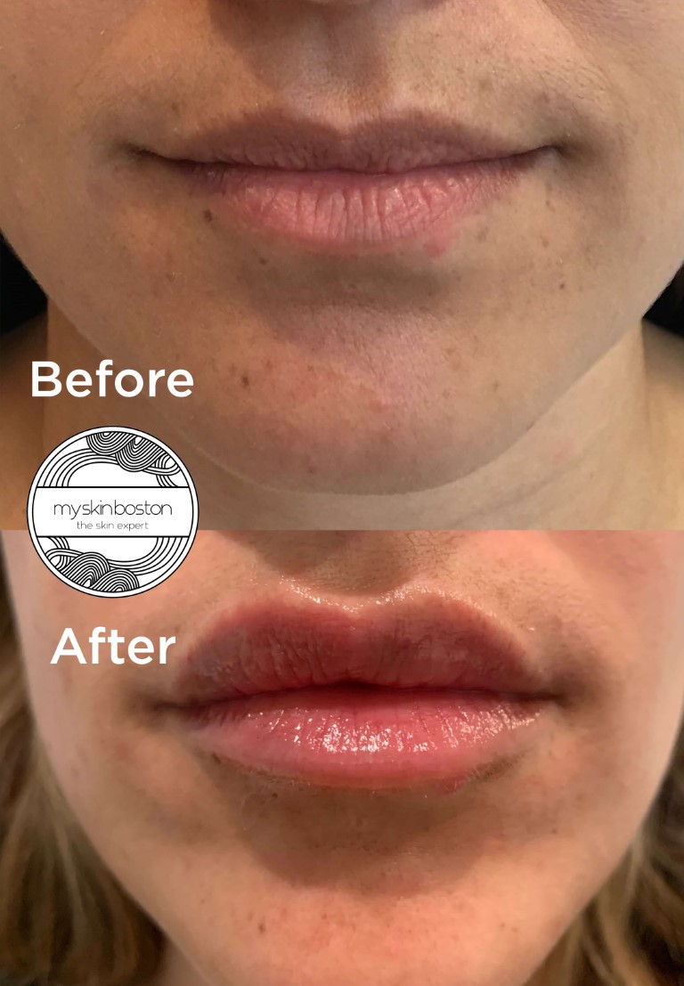 Facial Filler Before and After