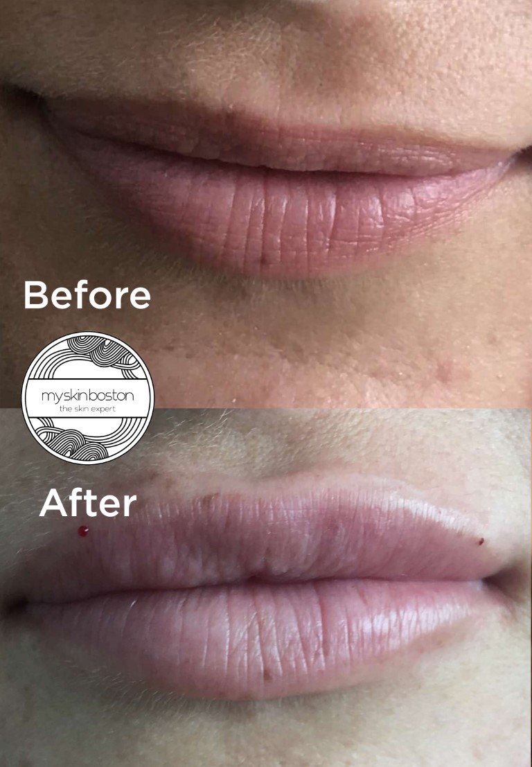 Facial Contouring Before and After