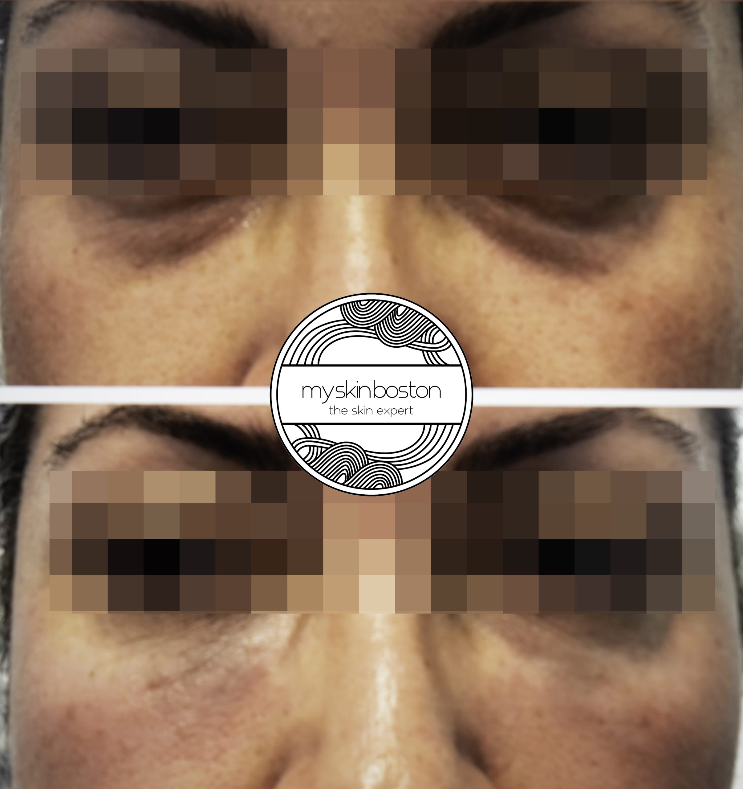 Under Eye Filler Before and After