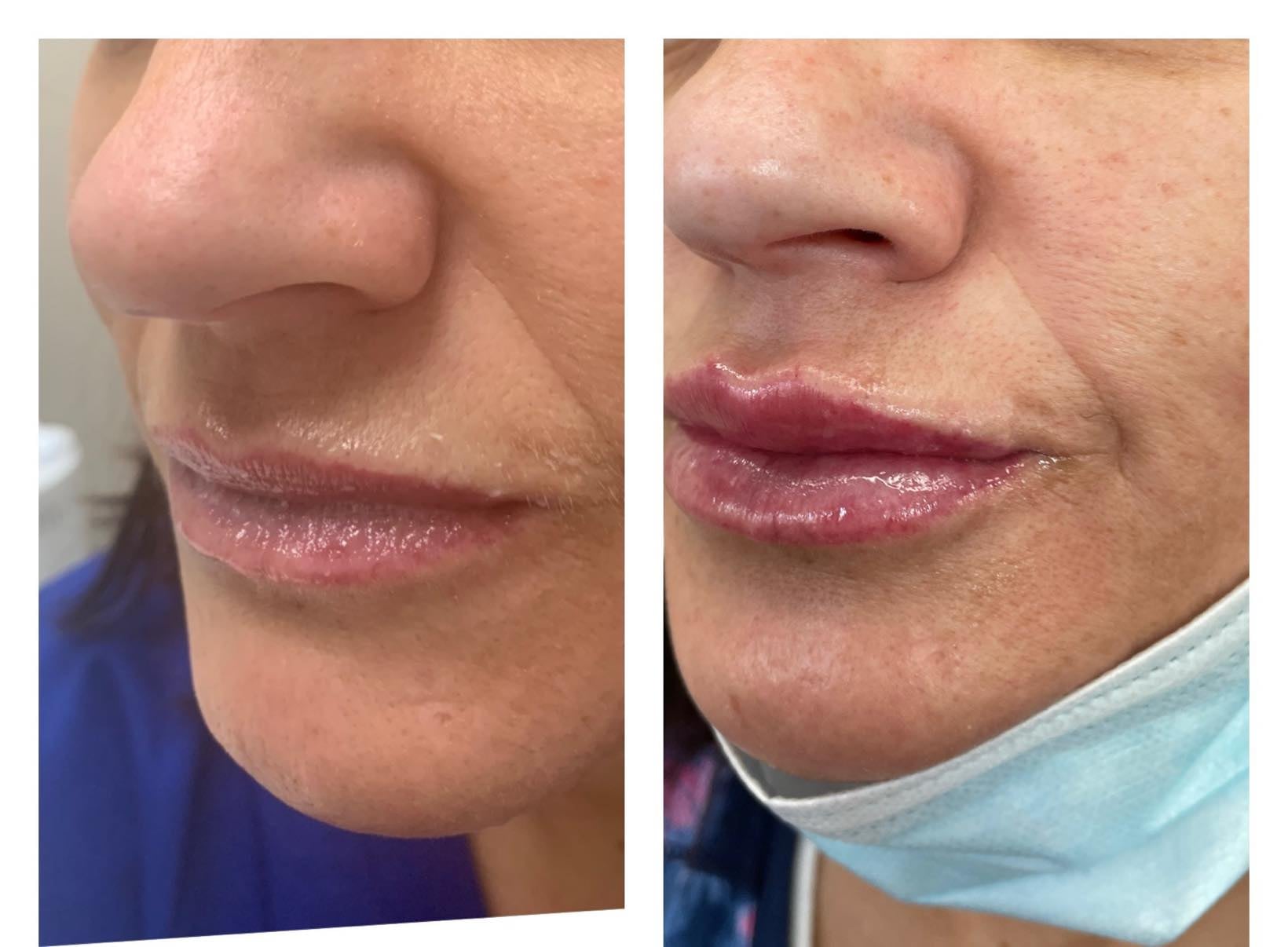 Lip Filler Before and After