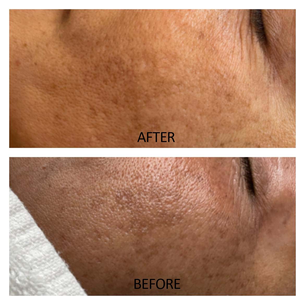 RF Micro Carbon Laser Before and After