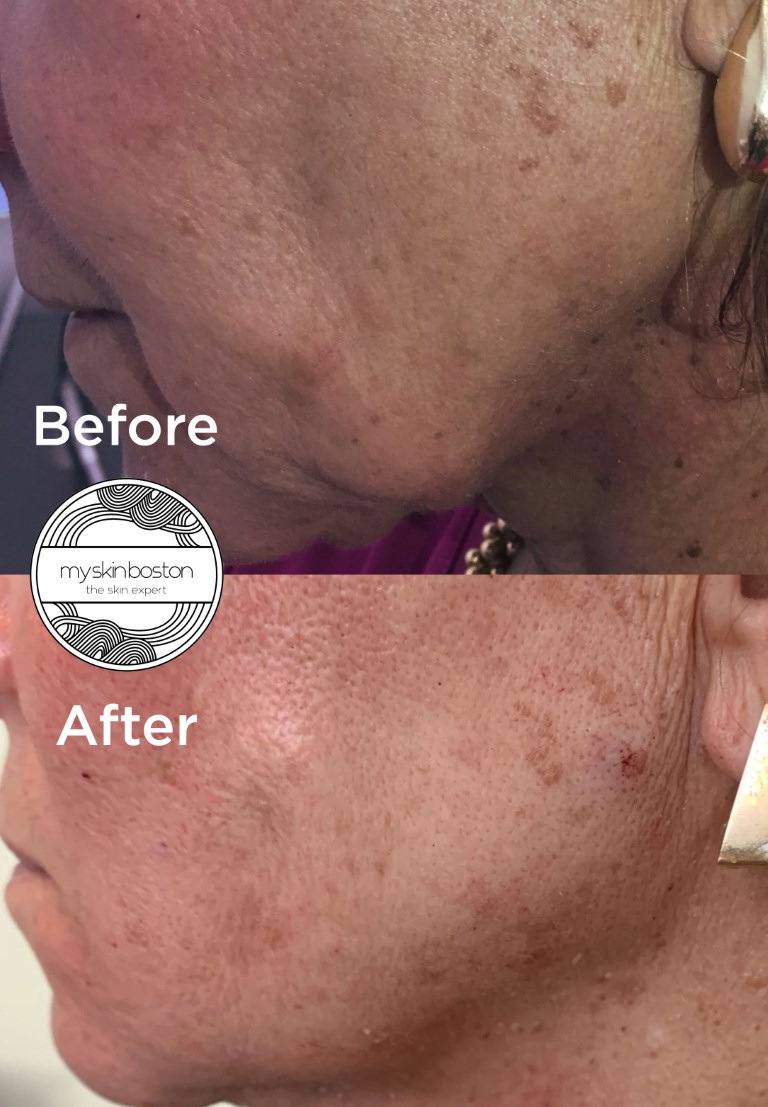 Thread Lift Before and After